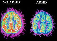 ADD no ADD Cat scan